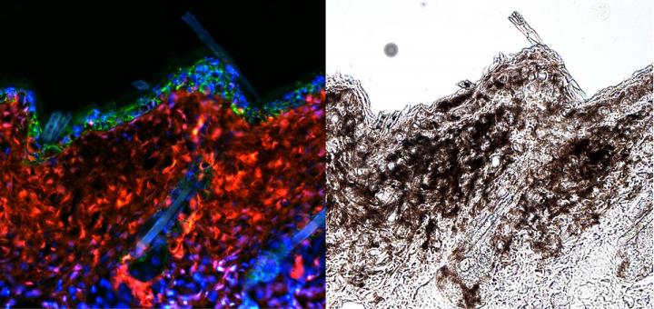 Melanoma