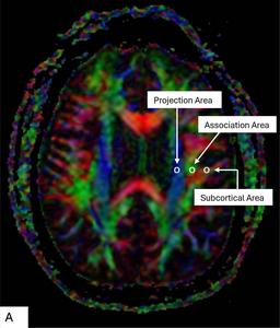 Color display of diffusion tensor imaging