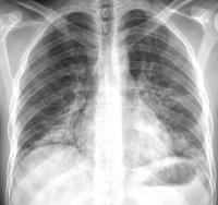 Radiology: Cardiothoracic Imaging Publishes Special Report on Vaping (1 of 2)