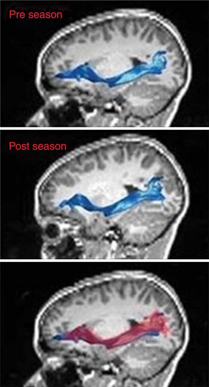 Figure 1 Left Inferior Fronto-Occipital Fasciculus