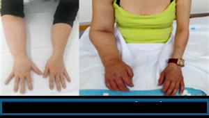 Radiotherapy rather than surgery may help reduce risk of lymphoedema in patients with breast cancer: results from pilot study