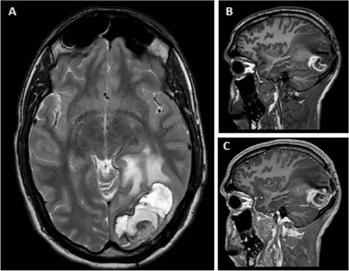 Magnetic resonance imaging (MRI) and intraoperative findings of a patient with delayed hematoma after radiosurgery for AVM