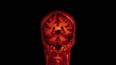 New Method Identifies Brain Regions Most Likely to Cause Epilepsy Seizures