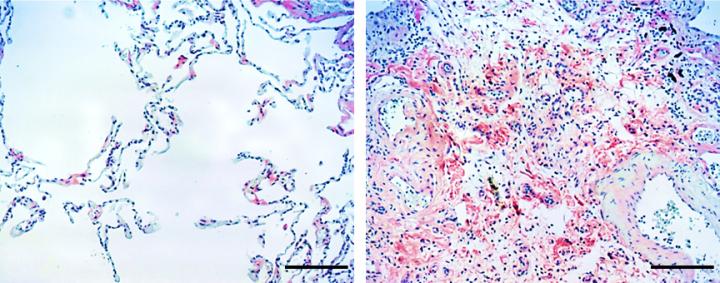 Lumican In Lungs