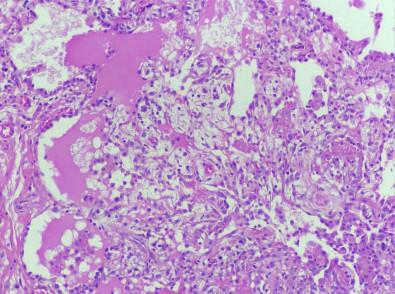 GATA2 deficiency