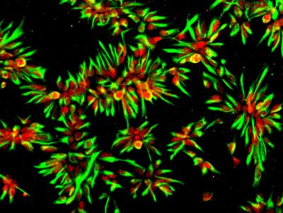 Neural Stem Cells Generated from iPS Cells Derived from a Patient with Alzheimer’s Disease