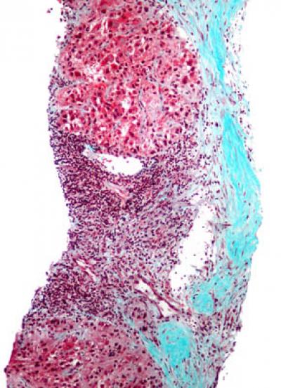 Liver Biopsy