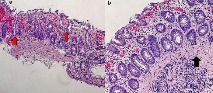 Early ischemic colitis