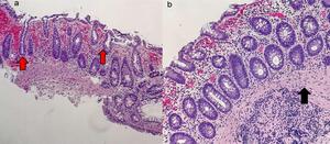 Early ischemic colitis