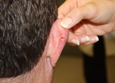 Basal Cell Carcinoma