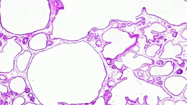 An Unusual Drug, Target vs. Metastatic Breast Cancer
