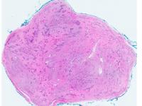 Stained Histopathology Slide of a Fibroadenoma