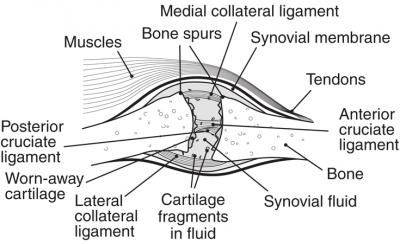 Osteoarthritis