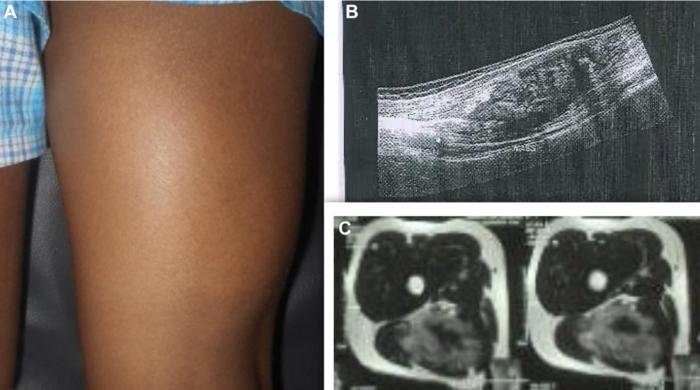 Solitary diffuse-type giant neurofibroma arising from the sciatic nerve in a 13-year-old: A rare occurrence