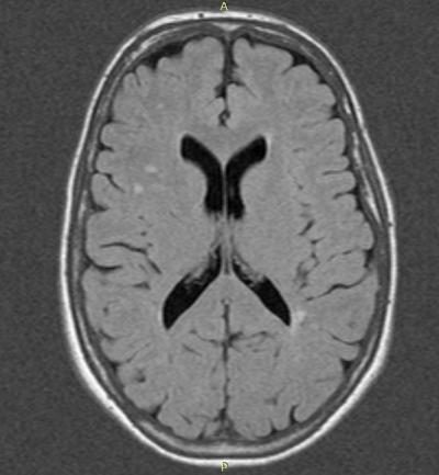 Brain with MRI Findings
