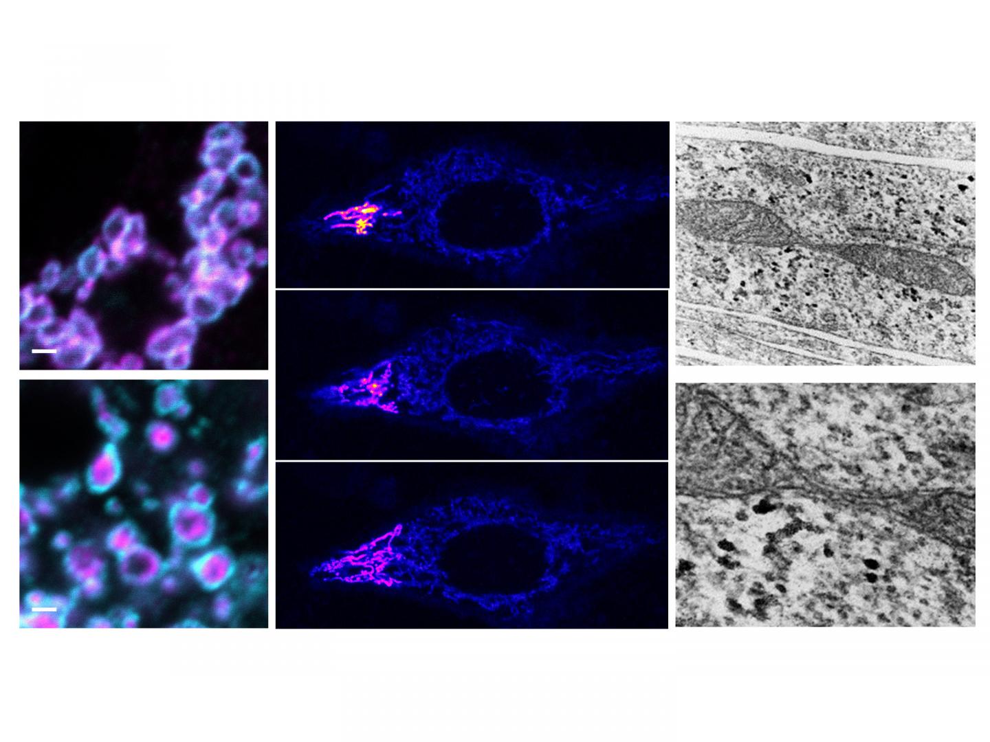 Researchers Finds a Novel Disease Gene Causing Neurodegenerative Conditions