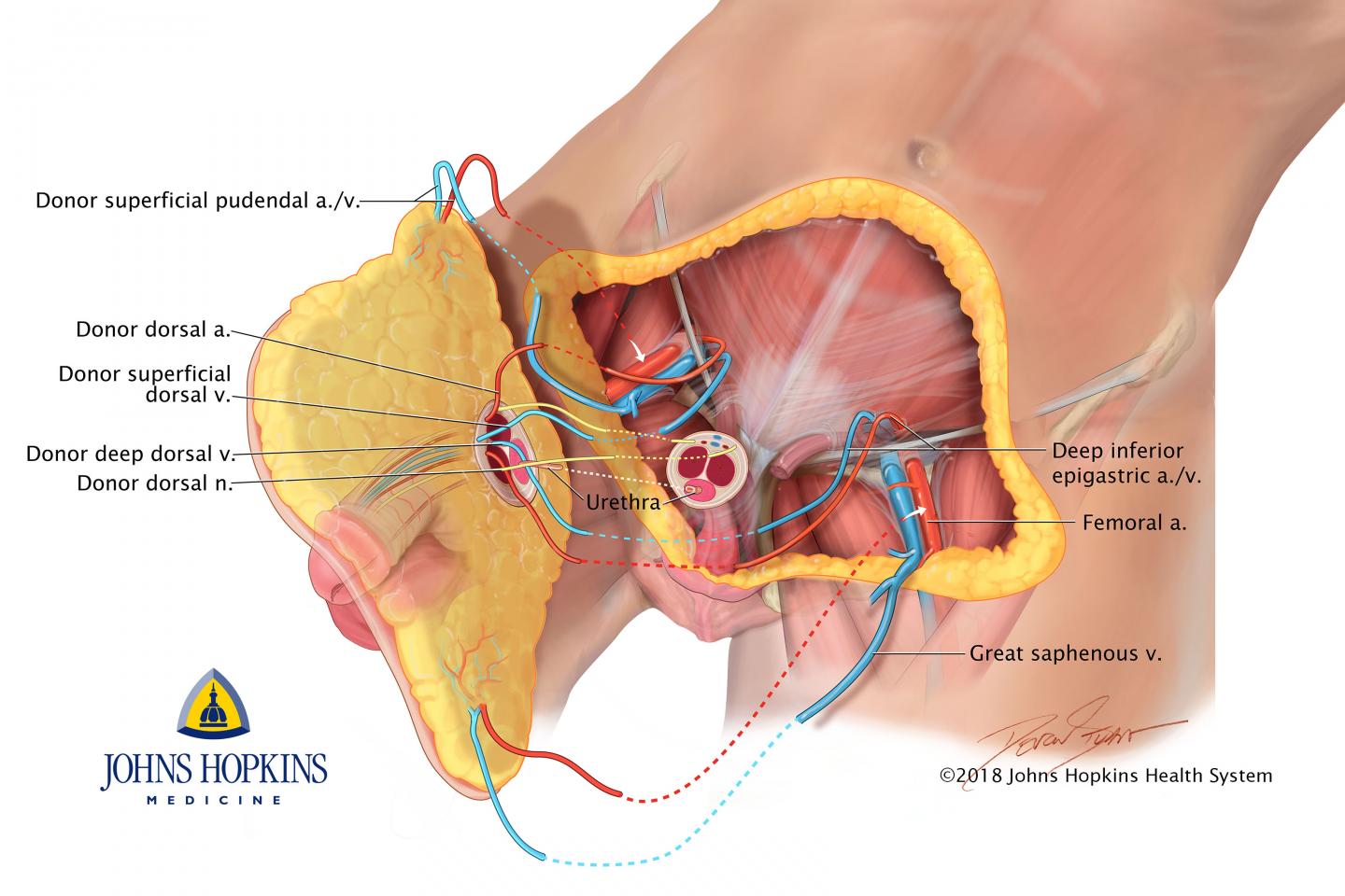 Penis Transplant
