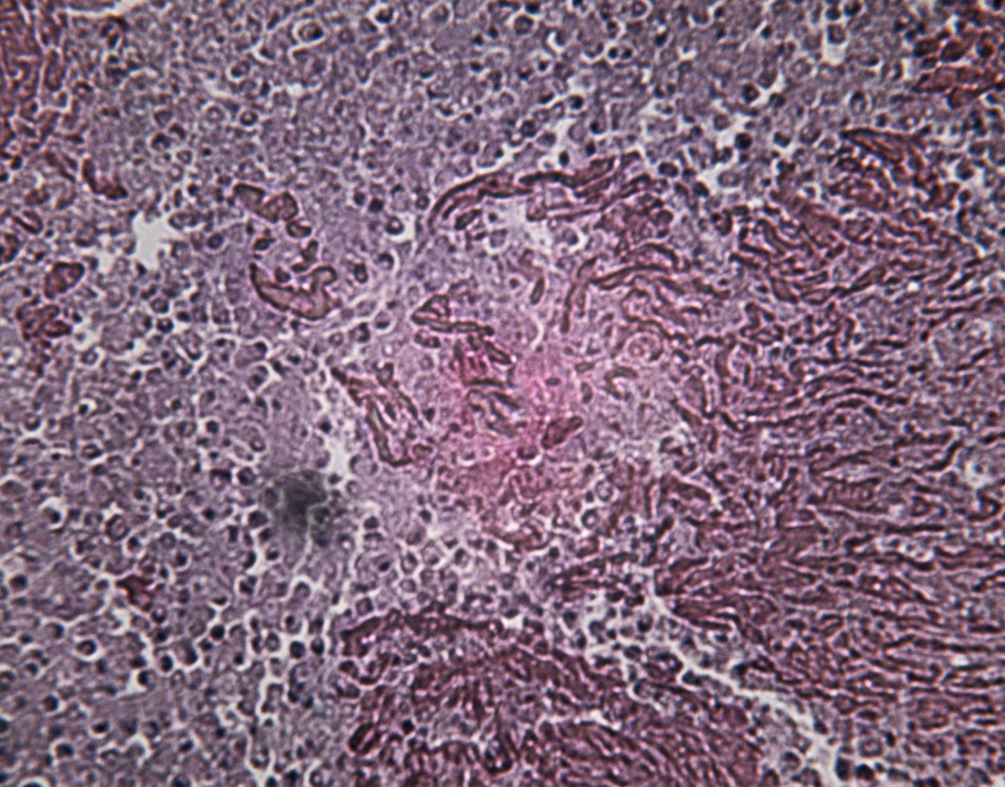 TB Diagnosis in Pregnant HIV Positive Women