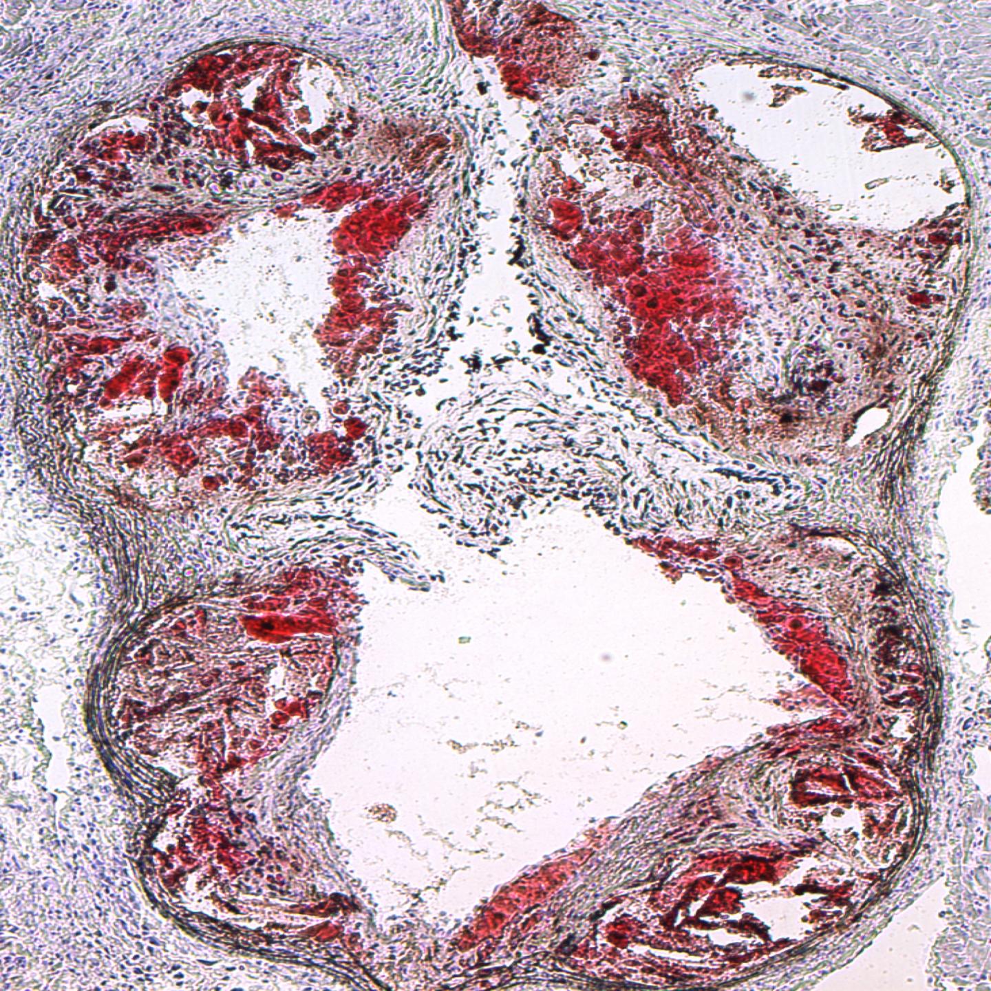 Atherosclerotic Lesions