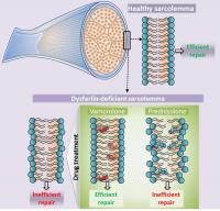 Figure: Lack of Dysferlin