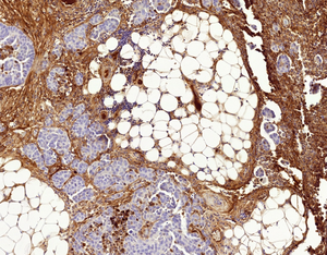 Probing the secrets of the cell to understand resistance to chemotherapy