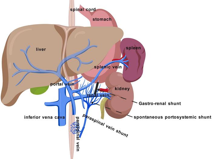 Occlusion of Paraspinal Vein Shunt Alleviated Post-TIPS Hepatic Myelopathy in a Patient with Cirrhosis