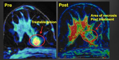 Pre- and Post-Treatment Transverse MR Image