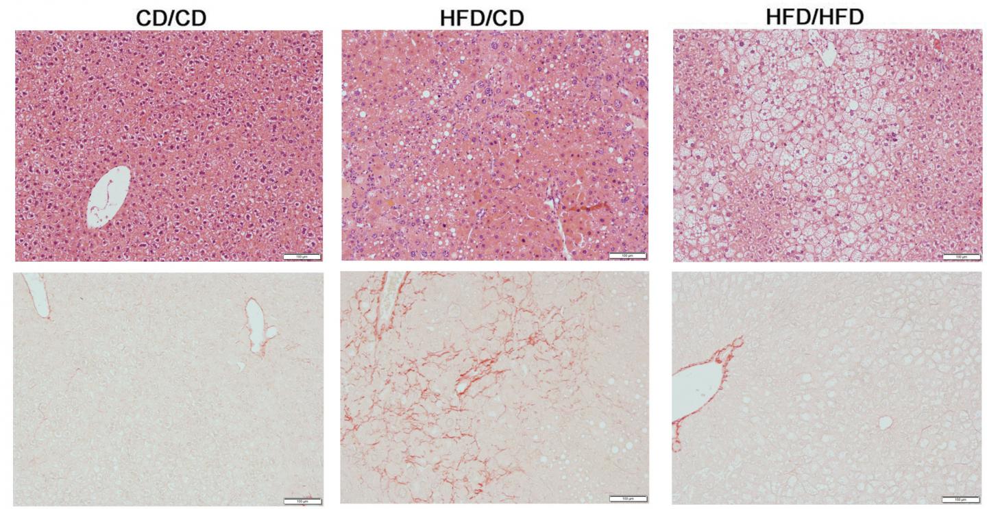 High Fat Diet and Liver Fibrosis