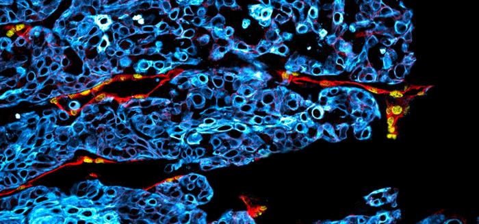 Microscopic image of a human oral cancer tumor