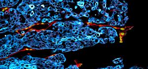 Microscopic image of a human oral cancer tumor