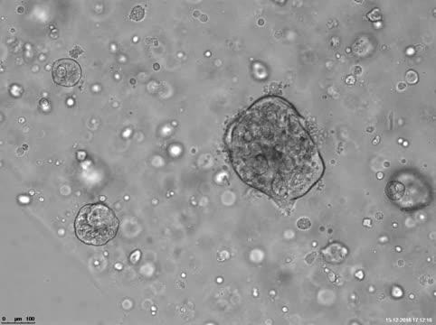 BAP1 Mutant Human Liver Organoids