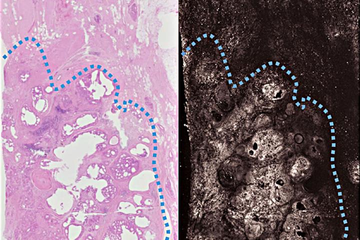 PA Imaging Breast Cancer
