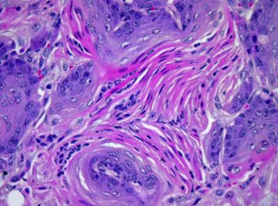 Histology of sox2/lkb1 Lung Tumors