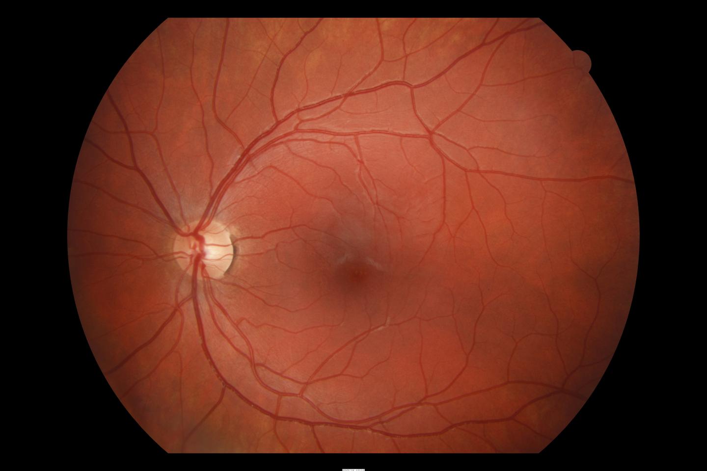 Retina