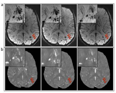 Microhemorrhages