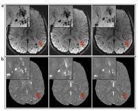 Microhemorrhages