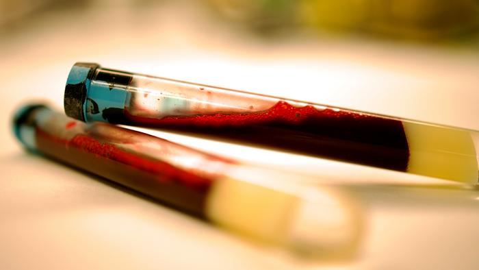 Early signs of Parkinson’s can be identified in the blood