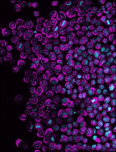 NAM phenomenon in many cancer cells