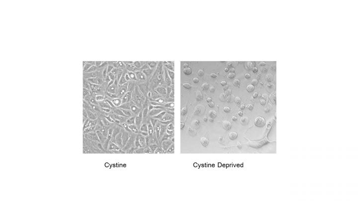 Cystine RCC