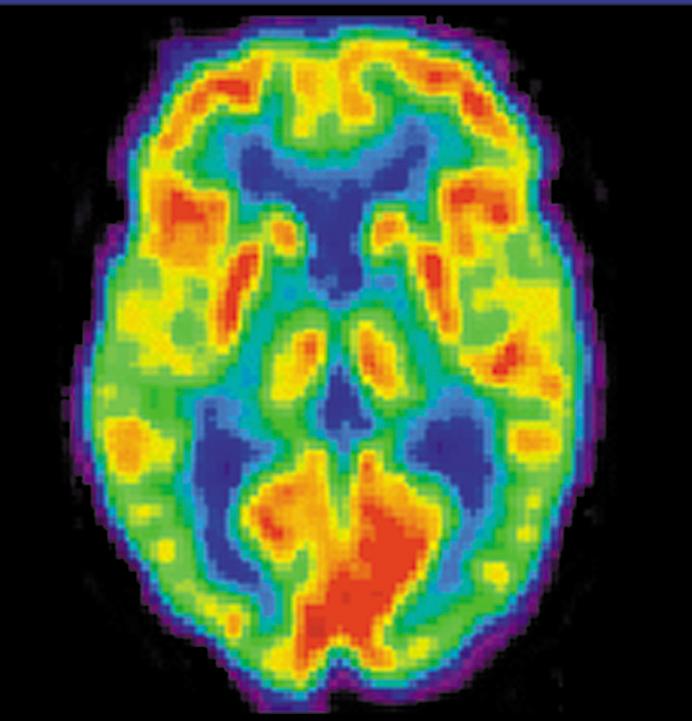 PET Scan