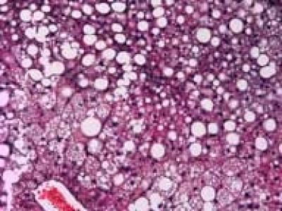 Fatty Liver