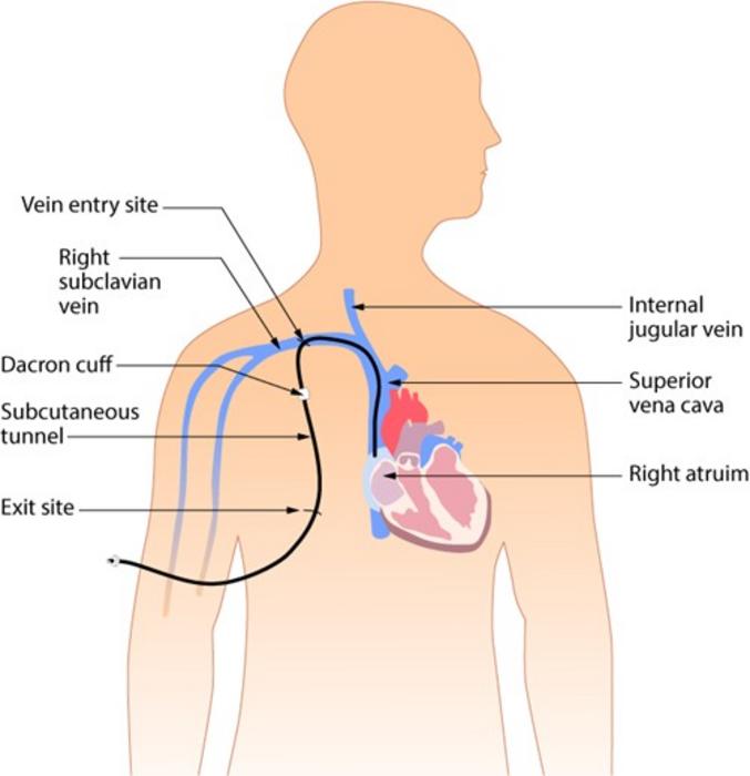 Positions of catheter insertion affect infection rates