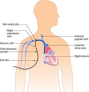 Positions of catheter insertion affect infection rates