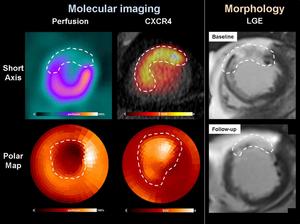 Example of 68-year-old male patient with anterior ST-segment elevation myocardial infarction and subsequent revascularization.