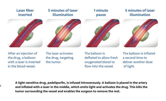 Image of how vascular targeted photodynamic therapy (VTP) works