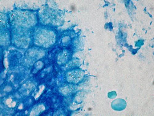 Shifting Bacterial Communities in the Stomach May Influence Cancer Risk