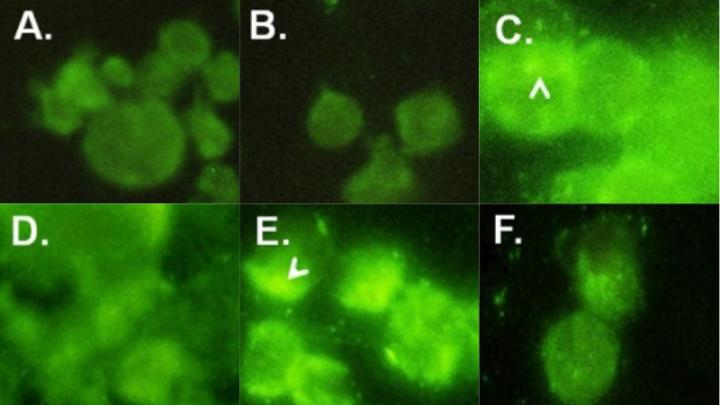 Treatment with the Drug D-PDMP Reduced beta-1,4-GalT-V Protein Level in Human Colorectal Cancer Cell