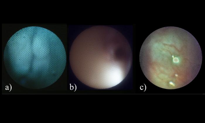 Fallopian tube images