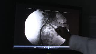 Stroke Prevention Study