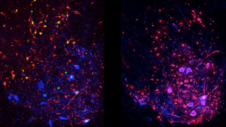 Disease Progression in Spinal Interneurons in Normal ALS Vs. Autophagy-Suppressed ALS Models